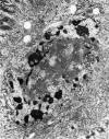 Third, the ground glass intranuclear inclusion bodies consisted of central, medium electron dense, finely granular material containing frequent herpesvirus nucleocapsids and partially surrounded or capped by prominent, clumped chromatin (Figure 3). 