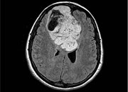 Black and white cross-cut image of brain showing contrasted color of tumor
