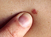 Finger pointing to skin cancer