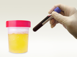 test tube of blood and urine sample in cup