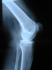 X-ray of knee joint