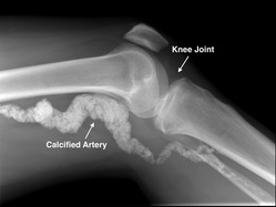 X-ray of knee joint showing calcified artery