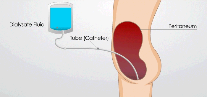 animation of manual PD exchange using a catheter