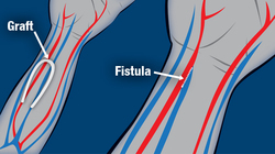 graft and fistula diagrams