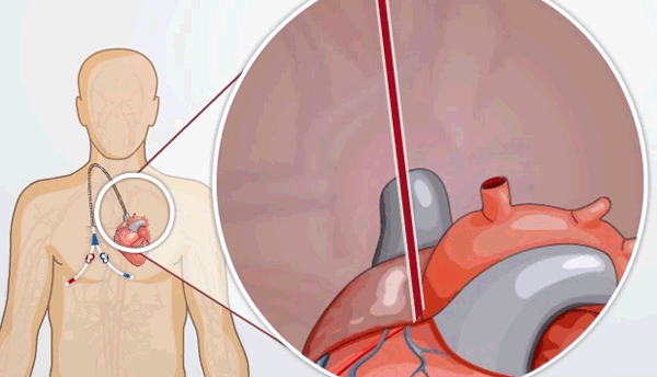 diagram of catheter and animation of germs entering the bloodstream through the catheter