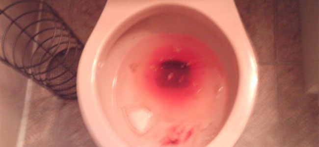 There was blood in my poop.  I’d tell the doctors, “Going to the bathroom hurts; can you please give me some kind of pain medication?” They’re like, “Oh, you’re an alcoholic, so we can’t give you pain meds. Why don’t you stop drinking?”  I’m like, “You know what, great idea. This is so easy; I’ll just stop something that makes the pain go away. I’ll get right on top of that. “