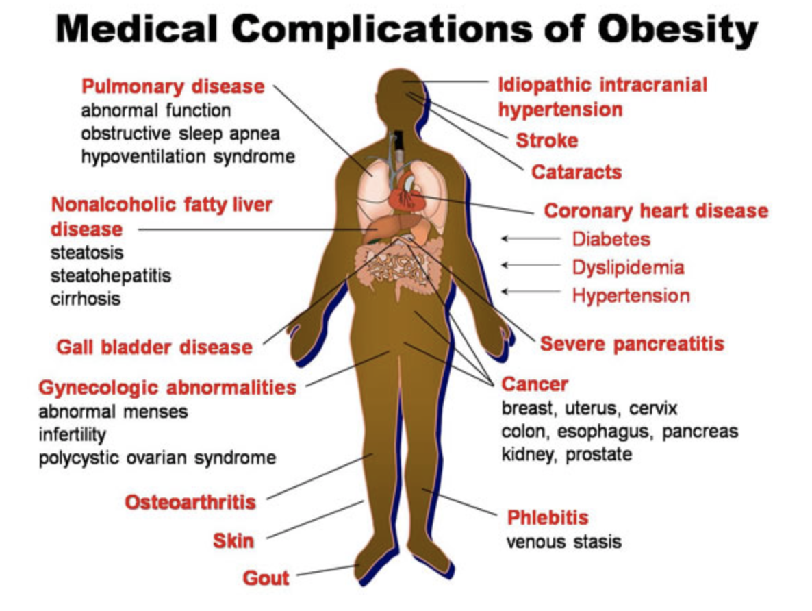 Diagram of the human body and the medical complications of obesity. Pulmonary disease include abnormal function, obstructive sleep apnea, hypoventilation syndrome. Nonalcoholic fatty liver disease include steatosis, steatohepatitis, cirrhosis. Gynecologic abnormalities include abnormal menses, infertility, polycystic ovarian syndrome. Cancer includes breast, uterus, cervix, colon, esophagus, pancreas, kidney, and prostate. Phlebitis includes venous stasis. Gall bladder disease, osteoarthritis, skin, gout, stroke, cataracts, coronary heart disease, diabetes, dyslipidemia, hypertension, and severe pancreatitis are also listed.