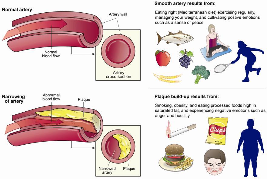 Four-part drawing. In the upper left is an image of a normal artery showing normal blood flow and no plaque. In the upper right shows the text "Smooth artery results from: Eating right (Mediterranean diet) exercising regularly, managing your weight, and cultivating positive emotions such as a sense of peace." With images of a fish, apple, grapes, wheat, broccoli, a woman sitting meditating and a silhouette of a person playing tennis. In the lower left is an image of the narrowing of artery with abnormal blood flow and plaque build-up. In the lower right shows the text: "Plaque build-up results from: Smoking, obesity, and eating processed foods high in saturated fat, and experiencing negative emotions such as anger and hostility" with images of a lit cigarette, bag of chips, a plate with large burger and fries on it, an angry hostile face and silhouette of a larger set person.