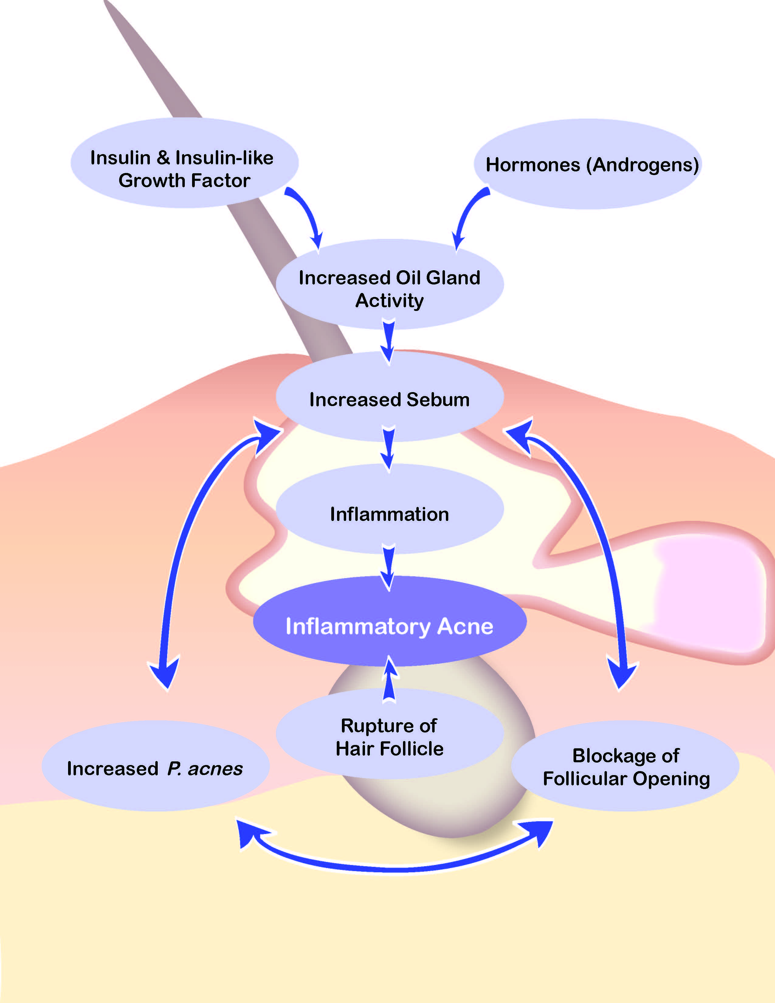 Acne Vulgaris Diagram