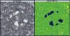 Exam by SEM and BEI (Figures 1 -3) demonstrate the presence of strongly back-scatter positive platy particles within the cytoplasm of some multinucleate giant cells.  