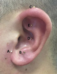 ear showing acupuncture points